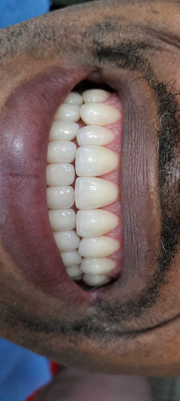 Resultado dental final del caso clínico 02