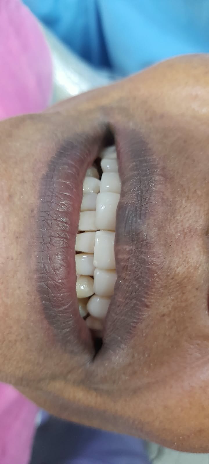 Resultado dental final del caso clínico 03