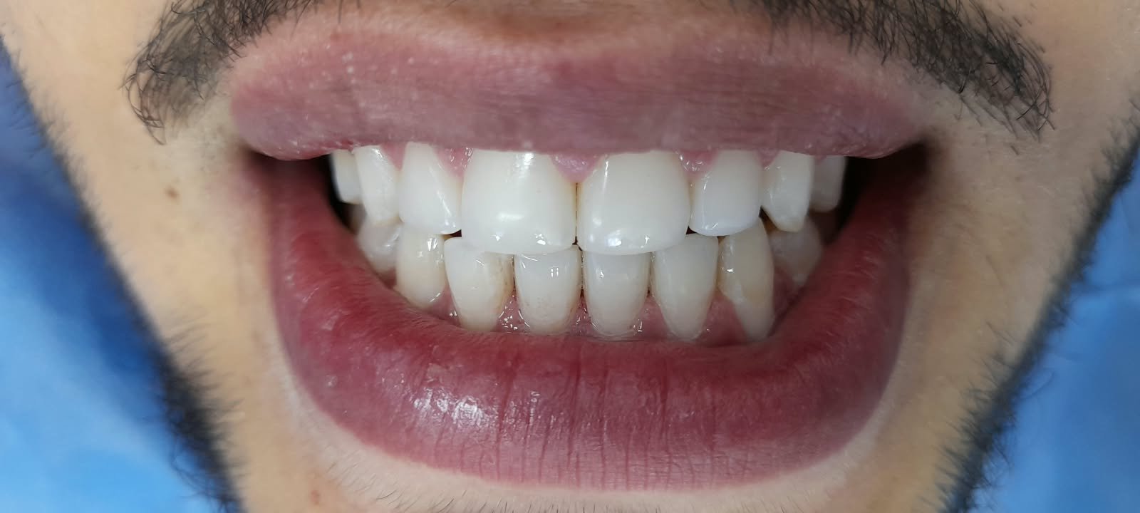 Resultado dental realizado en Sonri-Pluss